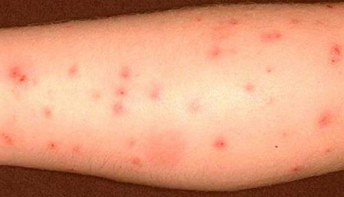 Чем мазать укусы клопов в домашних условиях. Чем мазать укусы клопов на теле человека: 2 вида лечения