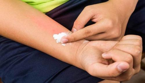 Чем мазать укусы клопов в домашних условиях. Чем мазать укусы клопов на теле человека: 2 вида лечения