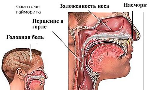 Чеснок в уши от гайморита. Как используется чеснок при лечении гайморита?