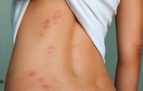 Как избавиться от постельных клопов в домашних условиях