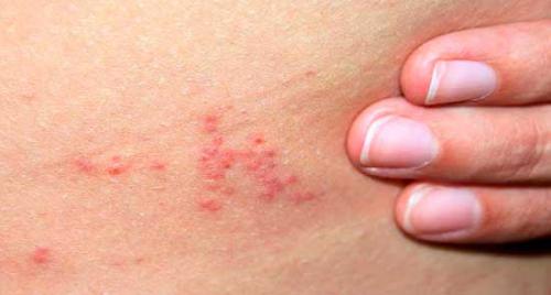 Как избавиться от клопов в диване. Клоповьи страсти: насекомые в диване