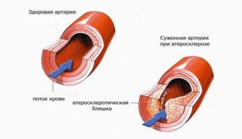 Чистка сосудов чесноком и лимоном неумывакин. Чистка сосудов чесноком и лимоном –, как проводить процедуру? Отзывы врачей