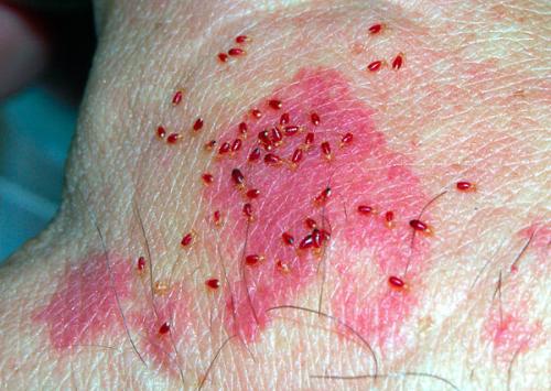 Почему нельзя давить клопов. 