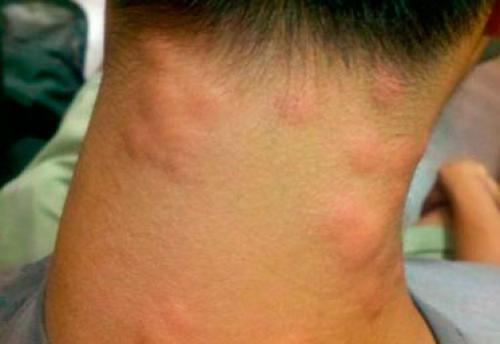 Как долго проходят укусы клопов. Как лечить укусы клопов?