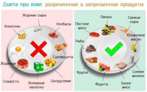 Запрещенные продукты при язве желудка. Запрещенные продукты
