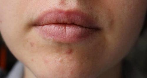 Борная кислота для чего. Борная кислота в растворе и порошке: инструкция по использованию для лечения ушей и при прыщах