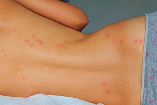 Клопы в квартире, как вывести. Как вывести клопов самостоятельно (личный опыт)