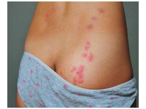 Клопы постельные признаки. Укусы – признак №1