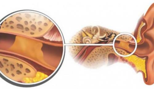 Борная кислота в уши при серных пробках. При серных пробках