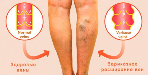 Чеснок и водка от варикоза. Лечение варикоза народными средствами