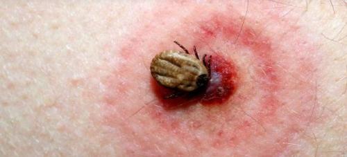 Укусы клопов, как определить. Как выглядят укусы клопов