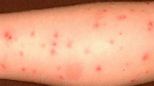 Укусы клопов, как определить. Как выглядят укусы клопов