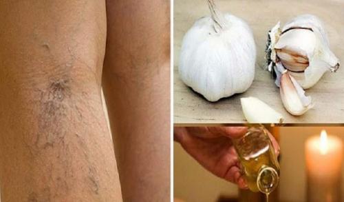 Чеснок и водка от варикоза. Чеснок для варикоза: рецепты и способ их применения