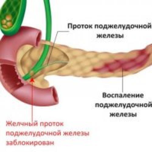 Хронический панкреатит сколько живут. Хронический панкреатит. Причины развития