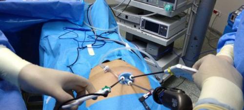 Камни в желчном пузыре 01