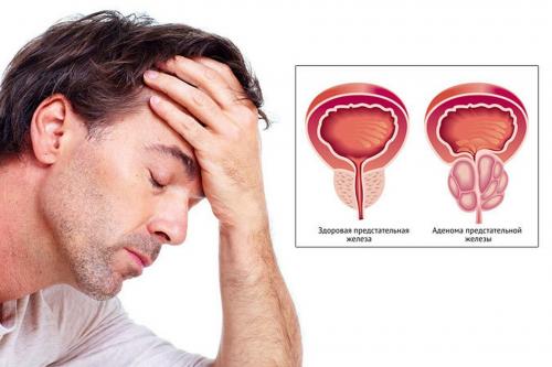 Как вылечить аденому предстательной железы. Симптомы аденомы простаты  02
