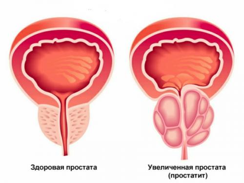 Топ-6 запретов при простатите. Чем же питание при простатите отличается от обычного меню? 05