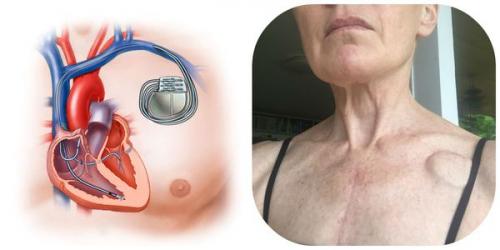 Лечение нарушений ритма сердца. Симптомы аритмии 01