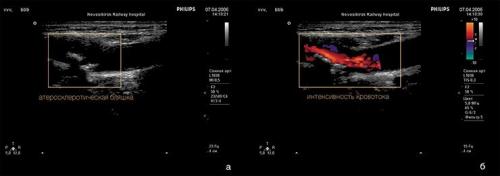 4 самых необходимых продукта при атеросклерозе. Полезные продукты при атеросклерозе 05 4 самых необходимых продукта при атеросклерозе. Полезные продукты при атеросклерозе 05