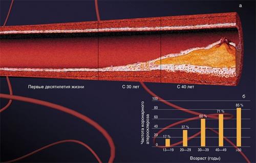 4 самых необходимых продукта при атеросклерозе. Полезные продукты при атеросклерозе 07 4 самых необходимых продукта при атеросклерозе. Полезные продукты при атеросклерозе 07