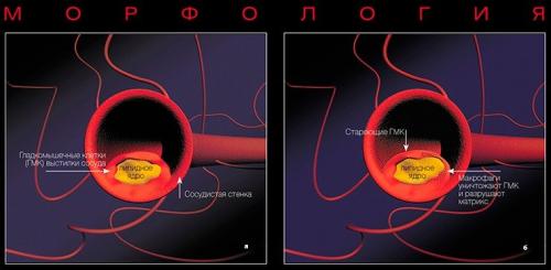 4 самых необходимых продукта при атеросклерозе. Полезные продукты при атеросклерозе 03 4 самых необходимых продукта при атеросклерозе. Полезные продукты при атеросклерозе 03