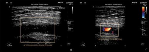 4 самых необходимых продукта при атеросклерозе. Полезные продукты при атеросклерозе 06 4 самых необходимых продукта при атеросклерозе. Полезные продукты при атеросклерозе 06