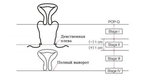 Что делать при опущении стенок влагалища. Определение болезни. Причины заболевания 02