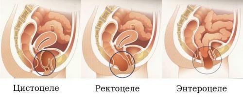 Что делать при опущении стенок влагалища. Определение болезни. Причины заболевания 01