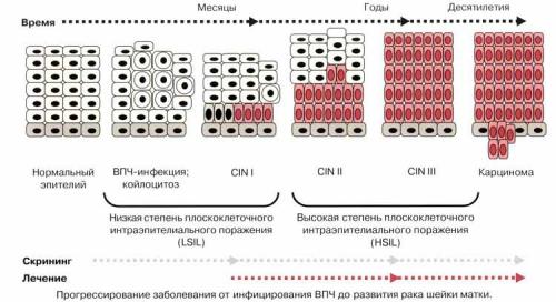 Что такое вирус папилломы человека и как его лечить. Папилломавирусная инфекция кожи и слизистых оболочек 01 Что такое вирус папилломы человека и как его лечить. Папилломавирусная инфекция кожи и слизистых оболочек 01