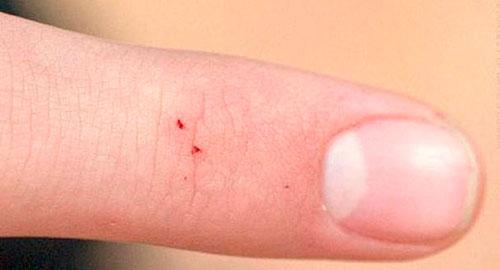 Больно ли кусаются тараканы. Кусаются ли тараканы и как выглядит укус?