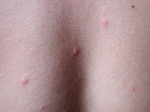 Ползают ли тараканы по людям. Может ли укусить домашний таракан?