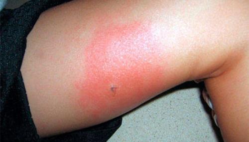 Ползают ли тараканы по людям. Может ли укусить домашний таракан?