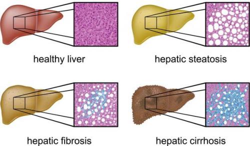 Диета при неалкогольной жировой болезни.. Как диагностируется НАЖБП? 03 Диета при неалкогольной жировой болезни.. Как диагностируется НАЖБП? 03