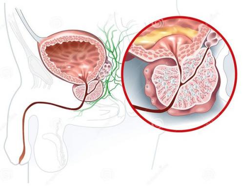Диета при аденоме простаты. Диета при простатите, аденоме 07 Диета при аденоме простаты. Диета при простатите, аденоме 07