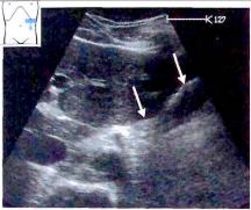 Как правильно определить причины несварения желудка: всё, что нужно знать 07